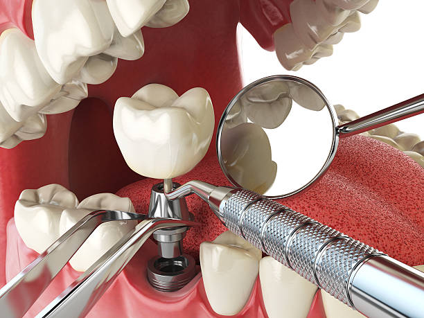 Best Emergency Dental Care for Sports Injuries in Hockinson, WA